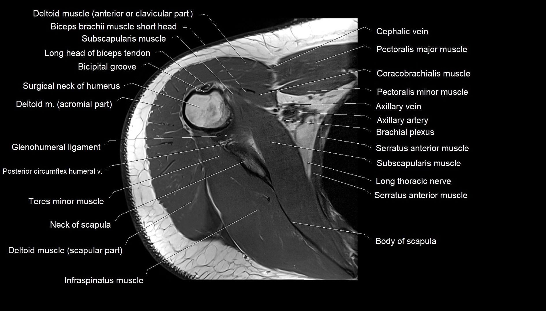 Shoulder cross sectional anatomy MRI 3T axial image 26.webp